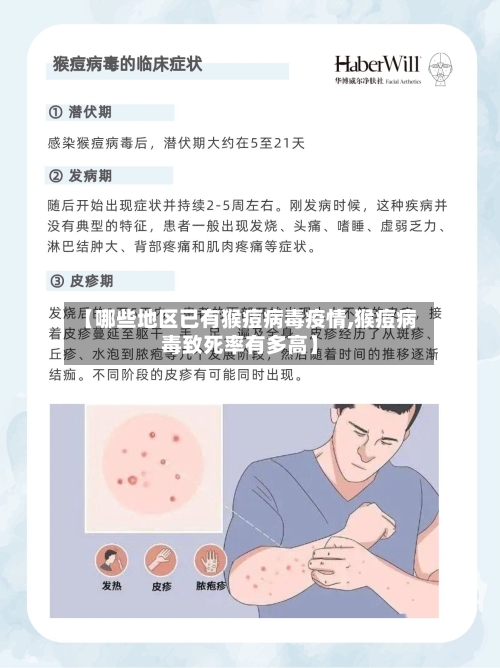 【哪些地区已有猴痘病毒疫情,猴痘病毒致死率有多高】-第1张图片